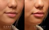 Patient 06 3/4th Right Side View Lip Augmentation Gabbay Plastic Surgery