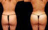 Back and side view of female patient results before and after liposuction to abdomen and waist with fat transfer to butt. Lipo results provided abdominal and waist contouring, slimming the figure while providing increased volume and shape to the buttocks. All volume increase is from injections with no artificial implants used. Note natural appearance and lack of visible scarring.