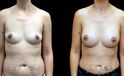 Breast Augmentation – Silicone