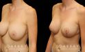 This patient had a previous breast augmentation with implants that she felt were far too big for her frame and not the look that she wanted. She had requested that her prior surgeon perform a breast lift because she had extreme breast droop or ptosis. Her surgeon chose to simply put in a large breast implant instead, and left her very unhappy. She came to Gabbay Plastic Surgery for a breast implant, revision and lift. Her implants were exchanged for smaller silicone implants, the pockets were closed into an appropriate size, and she underwent a breast lift to reduce the droop. Galaflex mesh was also used to keep her breasts lifted overtime. Over time, her scars almost completely disappeared, and she was extremely happy with her new look.
