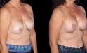 Procedures Depicted:  R&R + Breast Lift