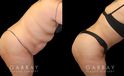 Tummy tuck patient photos from before and after the procedure. On the left, patient shows loose skin and significant banding/rolling of the skin. After the surgery, patient has tightened skin on all angles and note the absence of overhanging skin even when leaning forward.