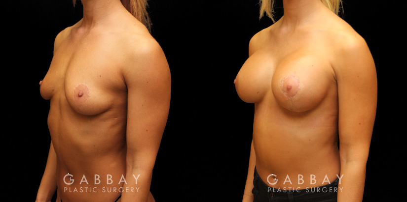 Procedures Depicted:  Implants repeal & replacement (left)