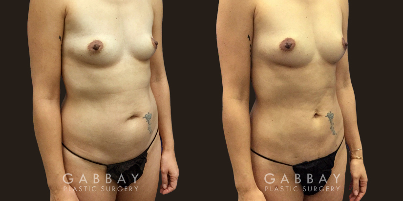 Procedures Depicted:  Breast Augmentation – Silicone Patient sought to remove final stubborn pockets of belly fat, restoring a more youthful figure and enhancing her natural figure.