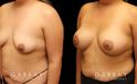 Silicone implant results. Patient increased breast size and used the implants to reduce breast drooping as well, without the need for mastopexy in addition.