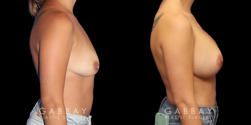 Procedures Depicted:  Breast Augmentation w/ Mastopexy – Silicone