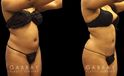 Younger female patient showcasing her results after belly fat removal via liposuction surgery. Note the reduction of ‘love handles’ and a flatter stomach for a defined lower torso aesthetic.