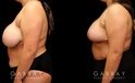 Patient 05 3/4th Left Side View Breast Reduction Gabbay Plastic Surgery