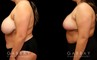 Patient 05 3/4th Left Side View Breast Reduction Gabbay Plastic Surgery