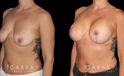 Procedures Depicted:  Wise Mastopexy with Silicone Breast Implants