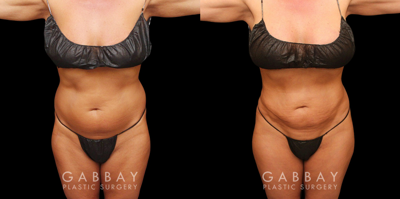 Procedures Depicted:  liposuction and j plasma to full abdomen Female African-American patient after liposuction and J plasma treatment to her full abdomen, reducing her bulging belly and to tighten and restore loose skin.
