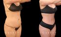 Patient photos of results from tummy tuck procedure at Gabbay Plastic Surgery. Patient recovered well, and results show a firmer, tighter abdominal area with notable improvements in silhouette and side angle views.