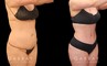 Patient photos of results from tummy tuck procedure at Gabbay Plastic Surgery. Patient recovered well, and results show a firmer, tighter abdominal area with notable improvements in silhouette and side angle views.
