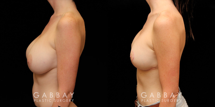 Procedures Depicted:  Breast Augmentation – Silicone & Lift
