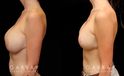 Procedures Depicted:  Breast Augmentation – Silicone & Lift