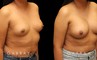 Using silicone implants, patient wanted a mild boost to breast volume without dramatic results. The final look has enhanced roundness while keeping to the patient’s natural breast shape and position before the procedure.