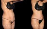 Multi-angle view of patient before and after tummy tuck combined with waist and arm liposuction. The combined approach allowed for results that balanced well with each other, creating a firmer body contour that maintained a natural look.