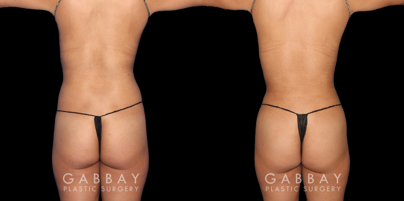 Procedures Depicted:  BBL, Lipo to Abdomen, Waist, and Tailbone, Fat Transfer to Butt. Before-and-after for patient with combined cosmetic surgeries, including BBL, abdominal lipo. Note the 360-degree slimming with enhanced buttocks roundness from the natural fat transfer.