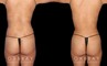 Procedures Depicted:  BBL, Lipo to Abdomen, Waist, and Tailbone, Fat Transfer to Butt. Before-and-after for patient with combined cosmetic surgeries, including BBL, abdominal lipo. Note the 360-degree slimming with enhanced buttocks roundness from the natural fat transfer.