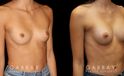 Patient before and after silicone breast augmentation. Patient’s slimmer body matched smaller implants to maintain a balance with her natural figure.