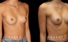 Patient before and after silicone breast augmentation. Patient’s slimmer body matched smaller implants to maintain a balance with her natural figure.