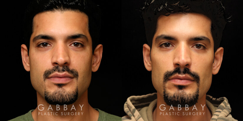 Procedures Depicted:  Buccal Fat Pad Removal