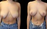 Patient 08 Front View Breast Reduction with Lift Gabbay Plastic Surgery