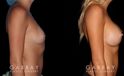 Breast augmentation before-and-after photos for patient with silicone implants. Increased volume resulted in pleasantly round breasts without excessive change.