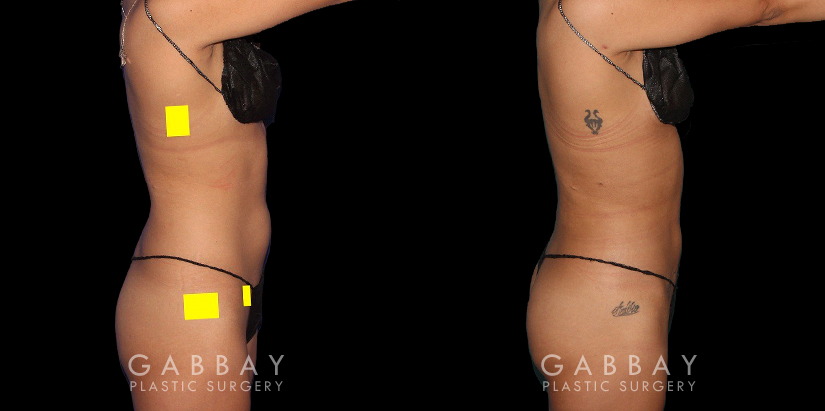 Procedures Depicted:  BBL, Lipo to Abdomen, Waist, and Tailbone, Fat Transfer to Butt. Before-and-after for patient with combined cosmetic surgeries, including BBL, abdominal lipo. Note the 360-degree slimming with enhanced buttocks roundness from the natural fat transfer.
