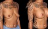 Patient breast augmentation results. The patient’s excess breast skin allowed for significant breast volume increase, most notable in the profile view.