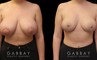 Patient 30 Front View Breast Mastopexy Gabbay Plastic Surgery