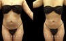 Before-and-after photo for 360 and abdominal liposuction combination. Note the emphasized contour of the waist, which in turn emphasizes the roundness of the buttocks.