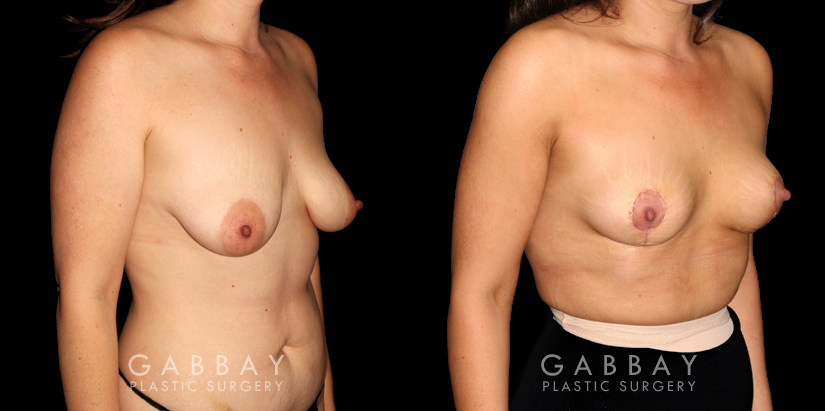Procedures Depicted:  Mastopexy and Liposuction
