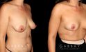 Procedures Depicted:  Mastopexy and Liposuction