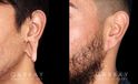 Patient 01 3/4th Left Side View Earlobe Repair Gabbay Plastic Surgery