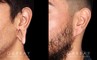 Patient 01 3/4th Left Side View Earlobe Repair Gabbay Plastic Surgery
