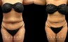 Patient after a traditional liposuction for the stomach (abdominal) area, resulting in a decrease in bulging belly fat (rolls) with a notable restoration of her natural body shape.