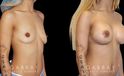 Silicone implant breast augmentation with correction of unilateral breast drooping. Results allowed for improved breast position without need for additional mastopexy procedure.