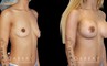 Silicone implant breast augmentation with correction of unilateral breast drooping. Results allowed for improved breast position without need for additional mastopexy procedure.