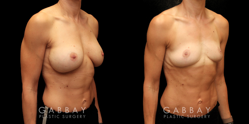 Procedures Depicted:  Implant removal/Mastopexy/Auto Augmentation