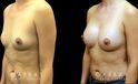Breast augmentation results for patient in her 40s. Volume increase is mild but retains a natural shape to the breasts with retained symmetry.