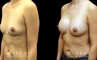 Breast augmentation results for patient in her 40s. Volume increase is mild but retains a natural shape to the breasts with retained symmetry.
