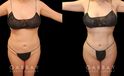 Effective liposuction combined with butt lift surgery enhanced patient’s body shape, shifting it from a more rectangular shape to a rounder, fuller shape with curves.