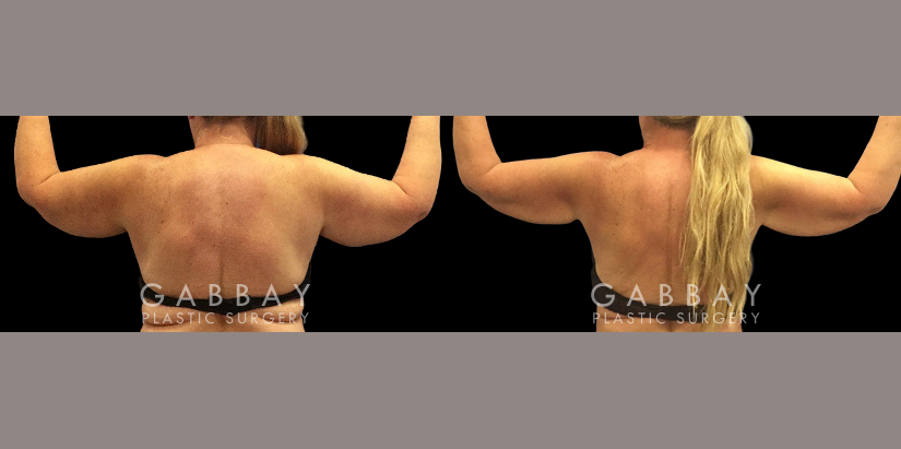 Procedures Depicted:  Tummy Tuck