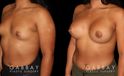 This is a young woman with a tuberous or constricted breast deformity. The lower portion of the breast developed more tightly than the rest of the breast. She wanted a more full, but natural breast appearance. She had silicone breast augmentation, with placement of an Allergan naturelle soft touch silicone breast implant through a lower breast/inframammary fold incision. Her moderate profile implants were 310 cc. Patients like this are prone to lower breast complications such as a double bubble, but with careful performance of the operation, she easily avoided this complication.