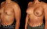 This is a young woman with a tuberous or constricted breast deformity. The lower portion of the breast developed more tightly than the rest of the breast. She wanted a more full, but natural breast appearance. She had silicone breast augmentation, with placement of an Allergan naturelle soft touch silicone breast implant through a lower breast/inframammary fold incision. Her moderate profile implants were 310 cc. Patients like this are prone to lower breast complications such as a double bubble, but with careful performance of the operation, she easily avoided this complication.