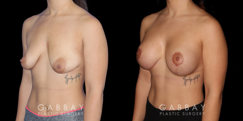 Procedures Depicted:  Breast Augmentation w/ Mastopexy – Silicone