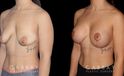 Procedures Depicted:  Breast Augmentation w/ Mastopexy – Silicone