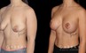 Procedures Depicted:  Breast Augmentation w/ Mastopexy – Silicone