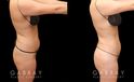 BBL post-op results showing well-settled butt injections for a mild increase in volume and enhancement of overall shape. 360 liposuction of the waist emphasizes the hourglass shape of the body and a natural-looking, slimmer silhouette. All post-op visits showed recovery without complications.